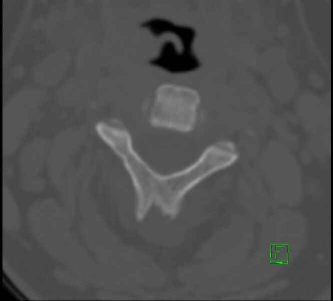 File:Cervical spine fracture - hyperflexion injury (Radiopaedia 66184-75364 Axial bone window 10).jpg