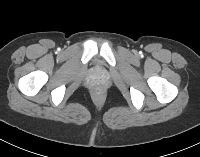 Cesarean scar endometriosis (Radiopaedia 82925-97262 A 89).jpg