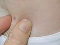 Chickenpox scars (DermNet NZ dermal-infiltrative-anetoderma03).jpg