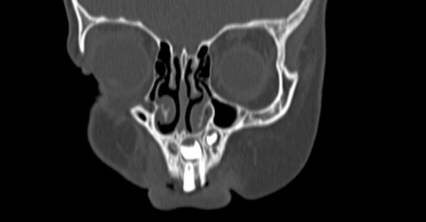 Choanal atresia (Radiopaedia 51295-56972 Coronal bone window 7).jpg