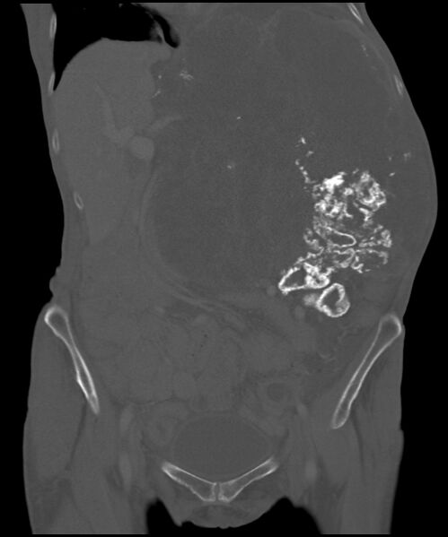 File:Chondrosarcoma of the spine (Radiopaedia 49871-55143 Coronal bone window 23).jpg