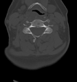Chordoma (C4 vertebra) (Radiopaedia 47561-52188 Axial bone window 28).png