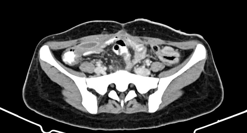 Choriocarcinoma liver metastases (Radiopaedia 74768-85766 A 152).jpg