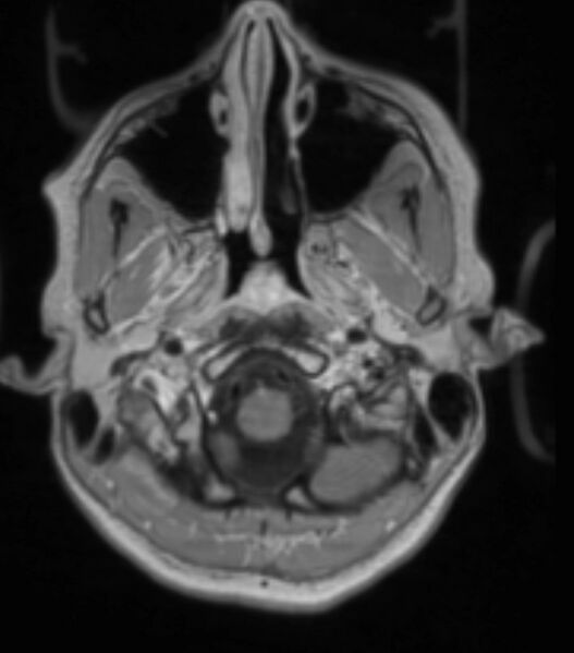 File:Choroid plexus carcinoma (Radiopaedia 91013-108553 Axial T1 C+ 79).jpg
