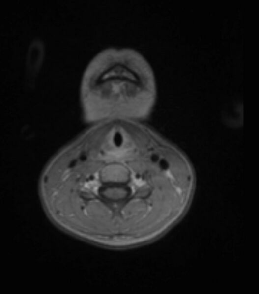 File:Choroid plexus carcinoma (Radiopaedia 91013-108553 Axial T1 C+ 8).jpg