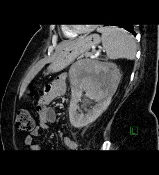 File:Chromophobe renal cell carcinoma (Radiopaedia 84239-99519 D 36).jpg
