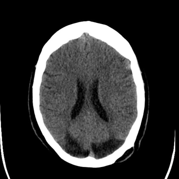 File:Chronic bilateral occipital lobe infarcts (Radiopaedia 31276-31996 Axial non-contrast 27).jpg