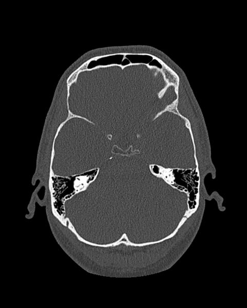 File:Chronic maxillary sinusitis caused by a foreign body (Radiopaedia 58521-65676 Axial bone window 269).jpg