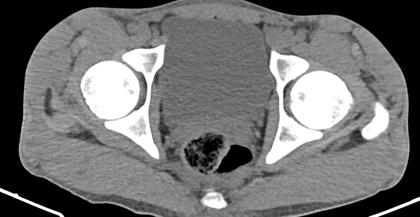 Chronic osteomyelitis (with sequestrum) (Radiopaedia 74813-85822 D 37).jpg