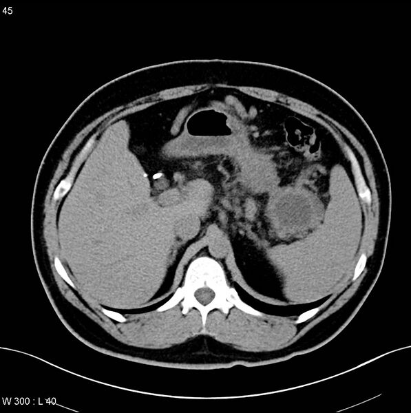 File:Chronic pancreatitis and pseudocysts (Radiopaedia 6724-7935 Axial non-contrast 3).jpg