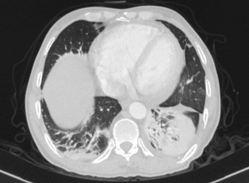 Chronic pulmonary embolism with bubbly consolidation (Radiopaedia 91248-108850 Axial lung window 119).jpg