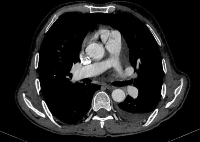 File:Chronic pulmonary embolism with bubbly consolidation (Radiopaedia 91248-108850 C+ arterial phase 74).jpg