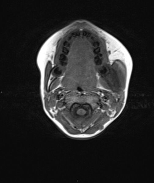 File:Chronic reactive multifocal osteomyelitis (CRMO) - mandible (Radiopaedia 56405-63069 Axial T1 12).jpg
