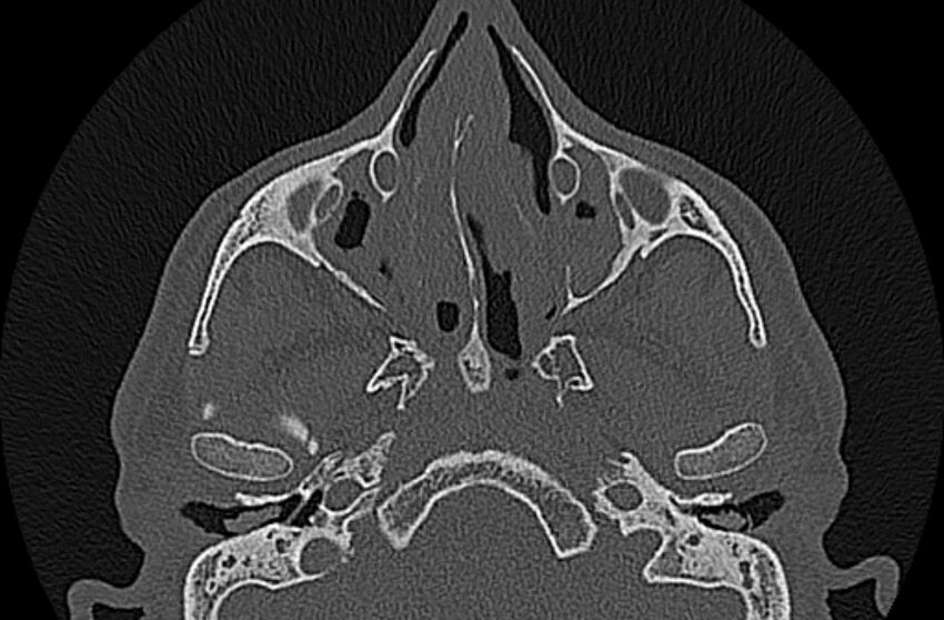 Chronic rhinosinusitis (Radiopaedia 65079-74075 Axial bone window 32).jpg