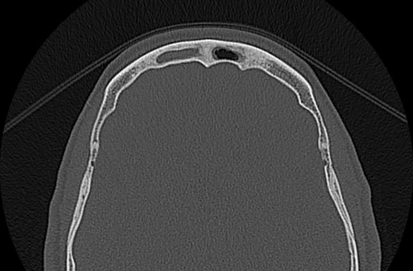 Chronic rhinosinusitis (Radiopaedia 65079-74075 Axial bone window 81).jpg