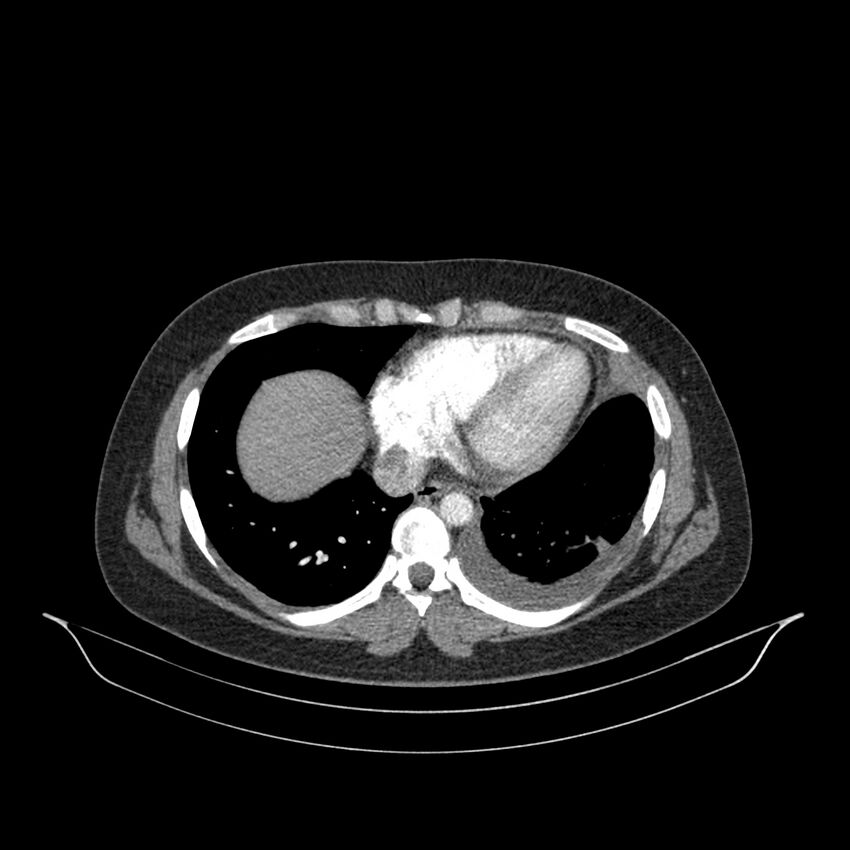 Chronic thromboembolic pulmonary hypertension (CTEPH) (Radiopaedia 74597-85532 Axial C+ CTPA 50).jpg