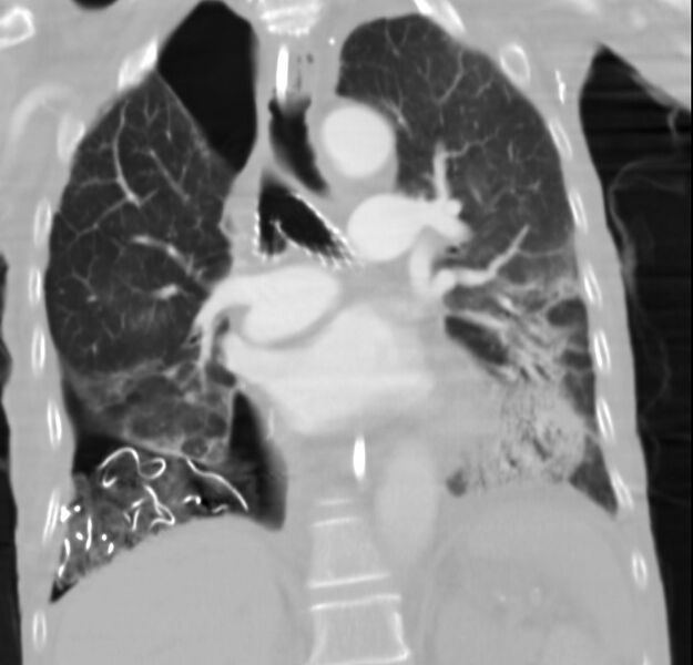 File:Clagett thoracotomy with bronchopleural fistula (Radiopaedia 29192-29587 Coronal lung window 15).jpg