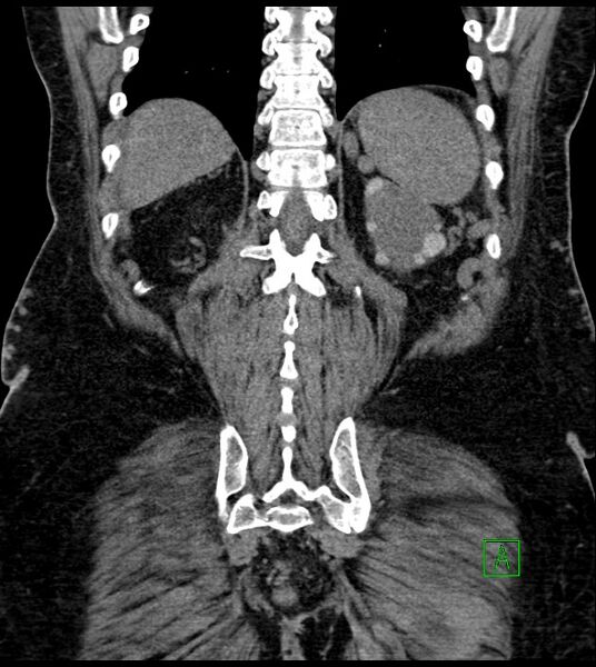 File:Closed-loop small bowel obstruction-internal hernia (Radiopaedia 78439-91096 Coronal non-contrast 81).jpg