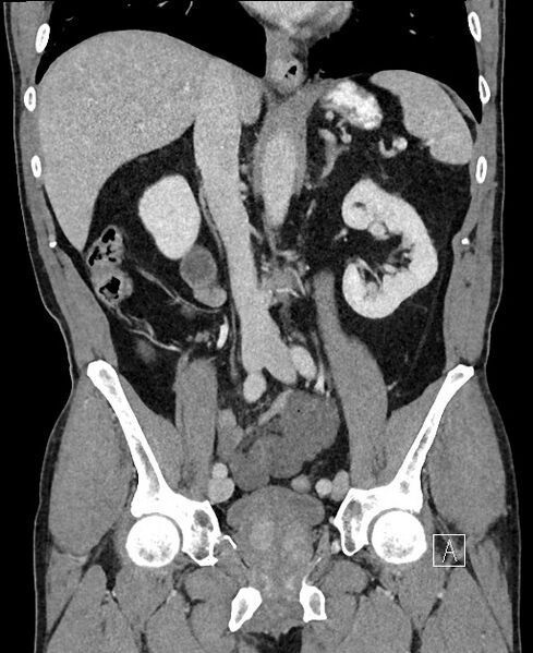 File:Closed loop small bowel obstruction - internal hernia (Radiopaedia 57806-64778 A 61).jpg