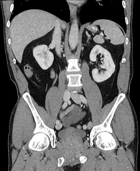 File:Closed loop small bowel obstruction - internal hernia (Radiopaedia 57806-64778 A 65).jpg