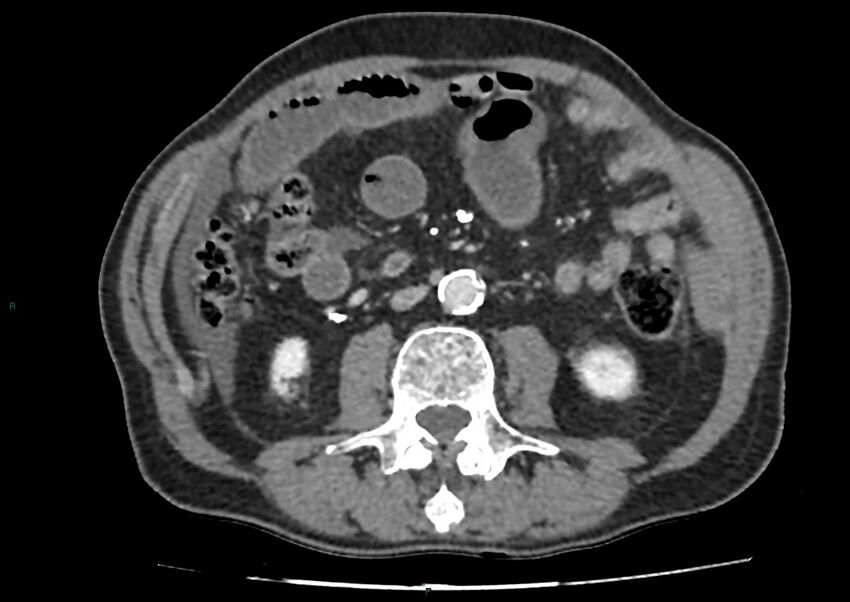Closed loop small bowel obstruction with ischemia (Radiopaedia 84180-99456 A 59).jpg