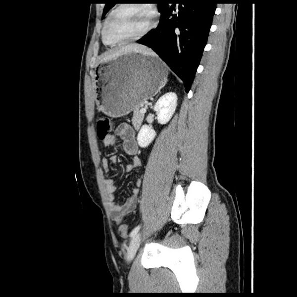 File:Co-existing acute appendicitis and epiploic appendagitis (Radiopaedia 61789-69911 B 65).jpg