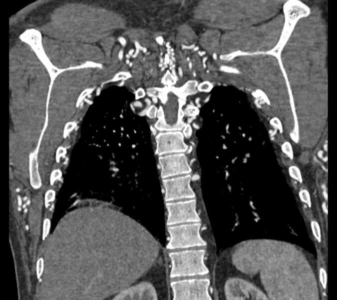 File:Coarctation of the aorta (Radiopaedia 53752-59822 B 63).jpg