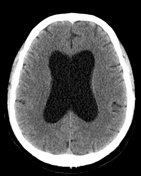 File:Colloid cyst of the third ventricle (Radiopaedia 86571-102661 Axial non-contrast 21).png