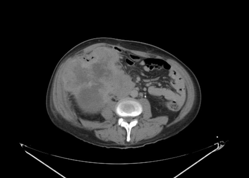 File:Colon cancer mimicking renal cell carcinoma (Radiopaedia 28986-29335 Axial C+ delayed 42).jpg