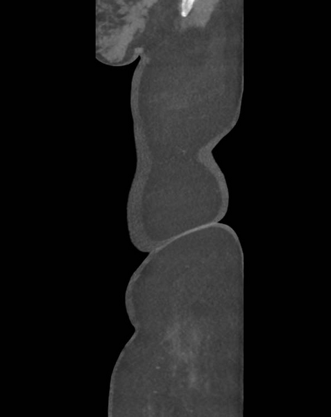 File:Colonic pseudo-obstruction (Radiopaedia 79752-92980 C 5).png