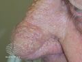 Grade 2 (DermNet NZ acne-rhinophyma-04).jpg