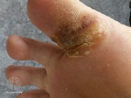 Hand-foot syndrome due to sorafenib