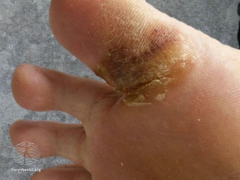 File:Hand-foot syndrome due to sorafenib (DermNet NZ HFS-5).jpg