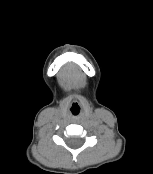 File:Nasoorbitoethmoid fracture (Radiopaedia 90044-107205 Axial non-contrast 32).jpg