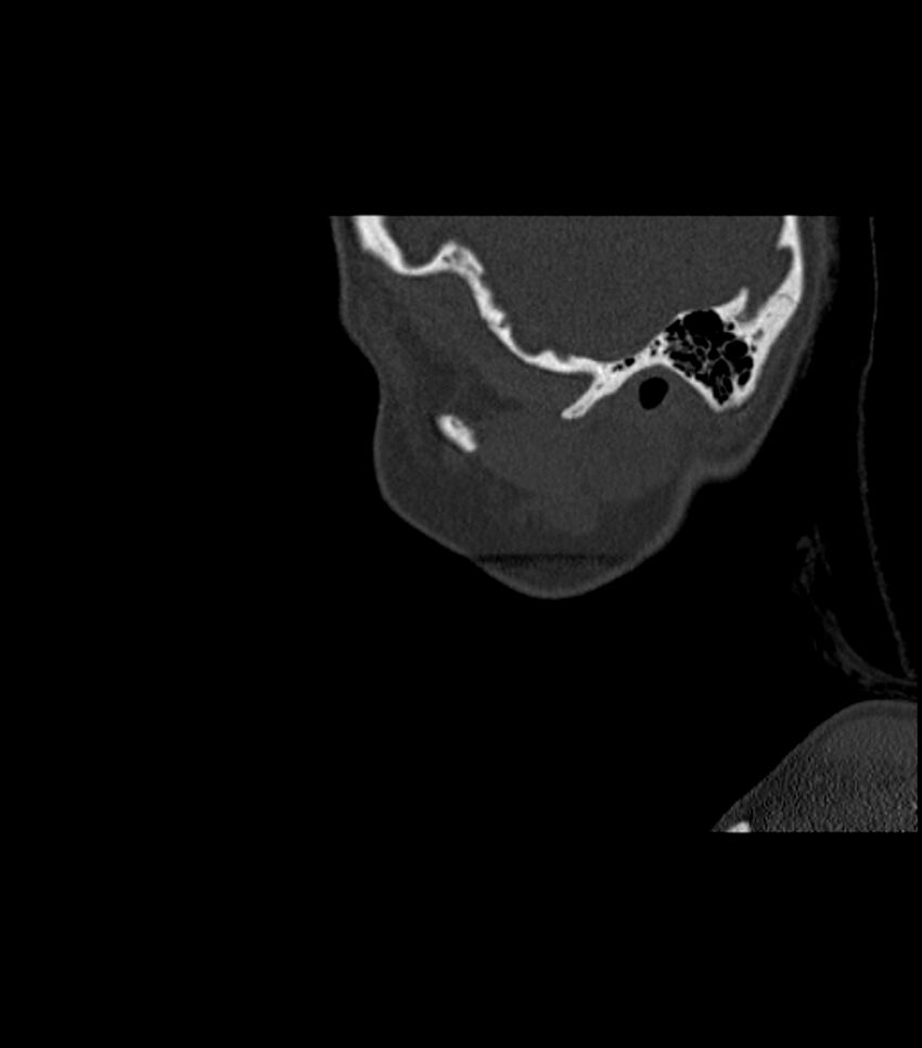 Nasoorbitoethmoid fracture (Radiopaedia 90044-107205 Sagittal bone window 126).jpg