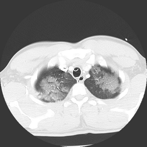 File:Near drowning pulmonary edema (Radiopaedia 16868-16591 Axial lung window 2).jpg