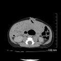 Neonatal neuroblastoma (Radiopaedia 56651-63438 Axial non-contrast 51).jpg