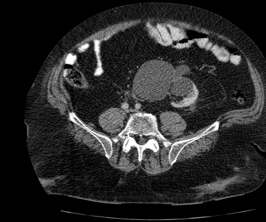 Nephroptosis with inguinal hernia containing perirenal fat (Radiopaedia 56632-63391 C 233).jpg