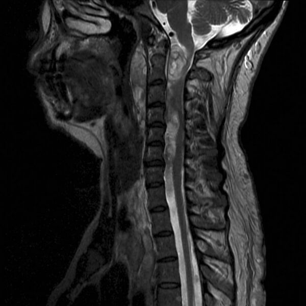 File:Neurofibromatosis type 1 (Radiopaedia 9159-9859 Sagittal T2 1).jpg