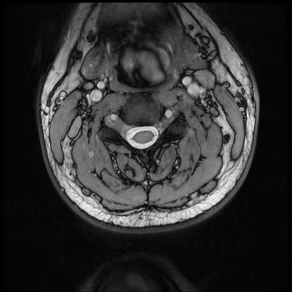 File:Neurofibromatosis type 2 (Radiopaedia 44936-48837 Axial Gradient Echo 31).png