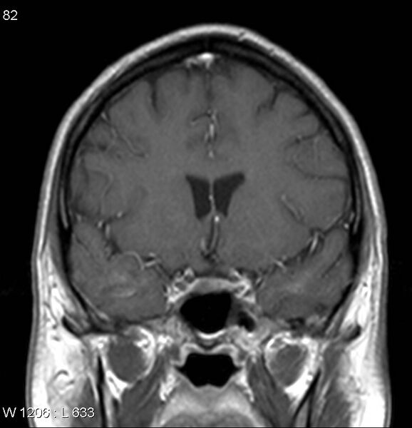File:Neurosarcoidosis (Radiopaedia 10930-17204 Coronal T1 C+ 6).jpg