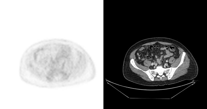 File:Non-Hodgkin lymphoma involving seminal vesicles with development of interstitial pneumonitis during Rituximab therapy (Radiopaedia 32703-33675 axial PET CT 16).jpg