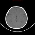 Non-accidental injury - bilateral subdural with acute blood (Radiopaedia 10236-10765 Axial non-contrast 11).jpg