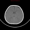 Non-accidental injury - bilateral subdural with acute blood (Radiopaedia 10236-10765 Axial non-contrast 13).jpg