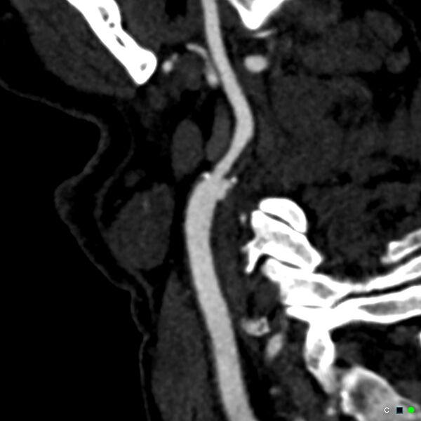 File:Non-occlusive intraluminal internal carotid artery thrombus (Radiopaedia 37751-39658 C 49).jpg