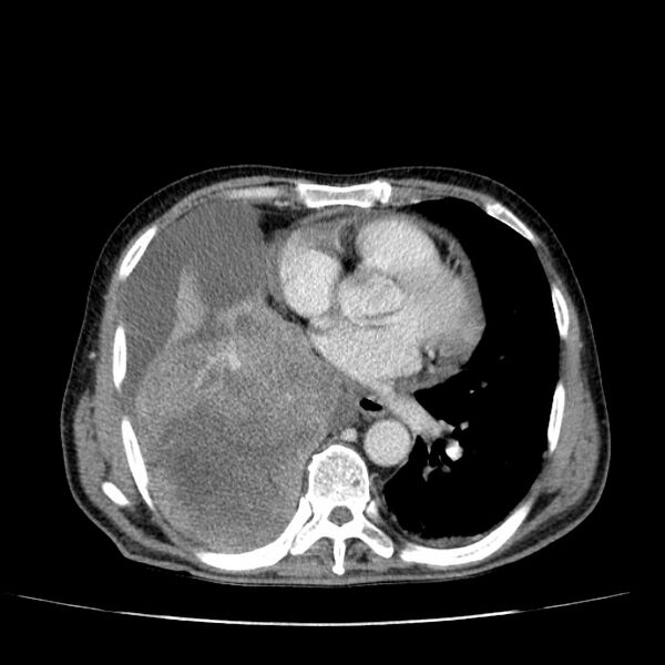 File:Non small-cell lung cancer (Radiopaedia 24467-24769 C+ delayed 38).jpg