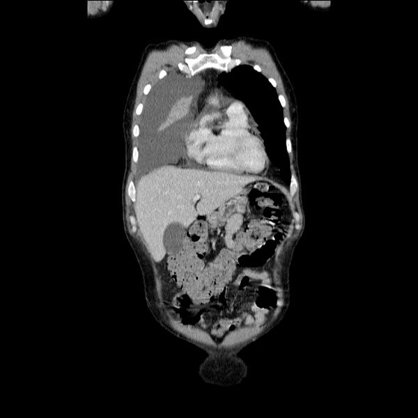 File:Non small-cell lung cancer (Radiopaedia 24467-24769 Coronal C+ delayed 15).jpg