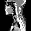 Normal CT of the neck (Radiopaedia 14575-14500 Sagittal C+ 25).jpg