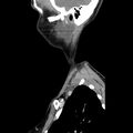 Normal CT of the neck (Radiopaedia 14575-14500 Sagittal C+ 45).jpg