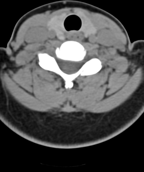 File:Normal cervical spine MRI (including Dixon) (Radiopaedia 42762-45926 Axial non-contrast 41).png